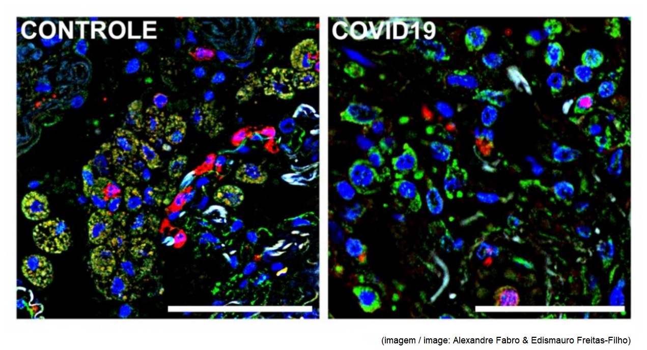 SARS-CoV-2 inhibits removal of dead cells by the immune system, favoring lung damage