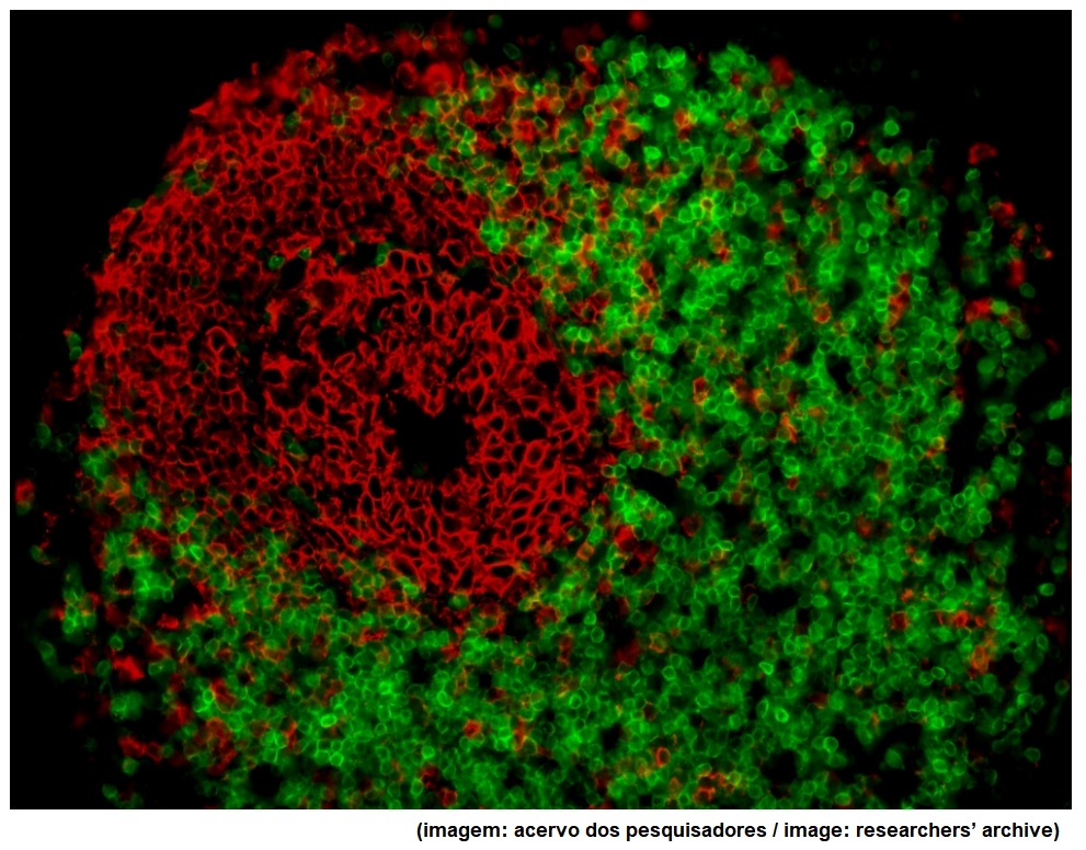 Study identifies genes that are altered in Crohn’s disease patients